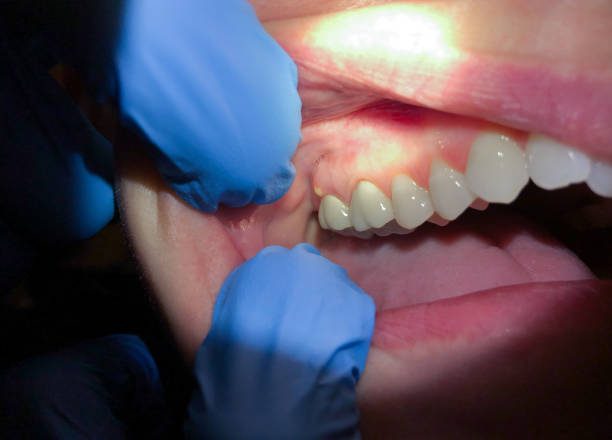 Best Emergency Dental Care for Broken or Chipped Teeth in Fort Bragg, CA