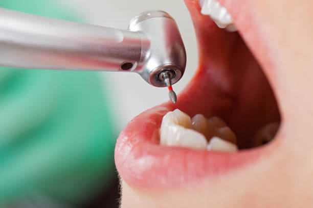Best Emergency Treatment for Dental Infections or Abscesses in Fort Bragg, CA